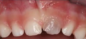 Teeth 1